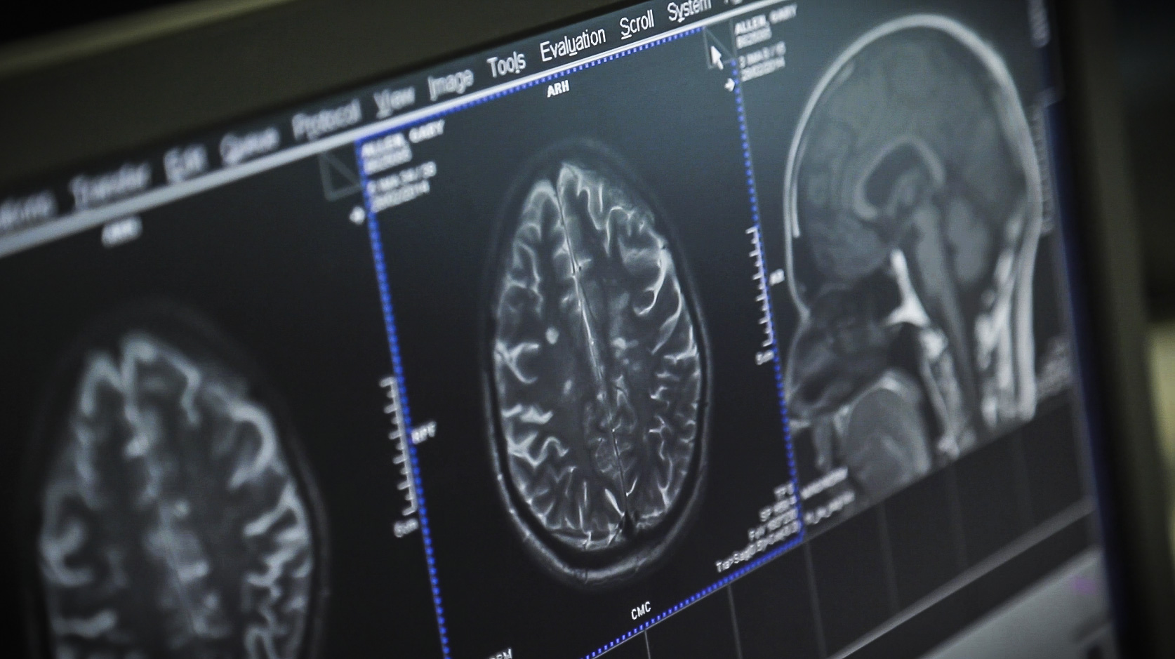 An MRI Scan of a brain on a computer screen