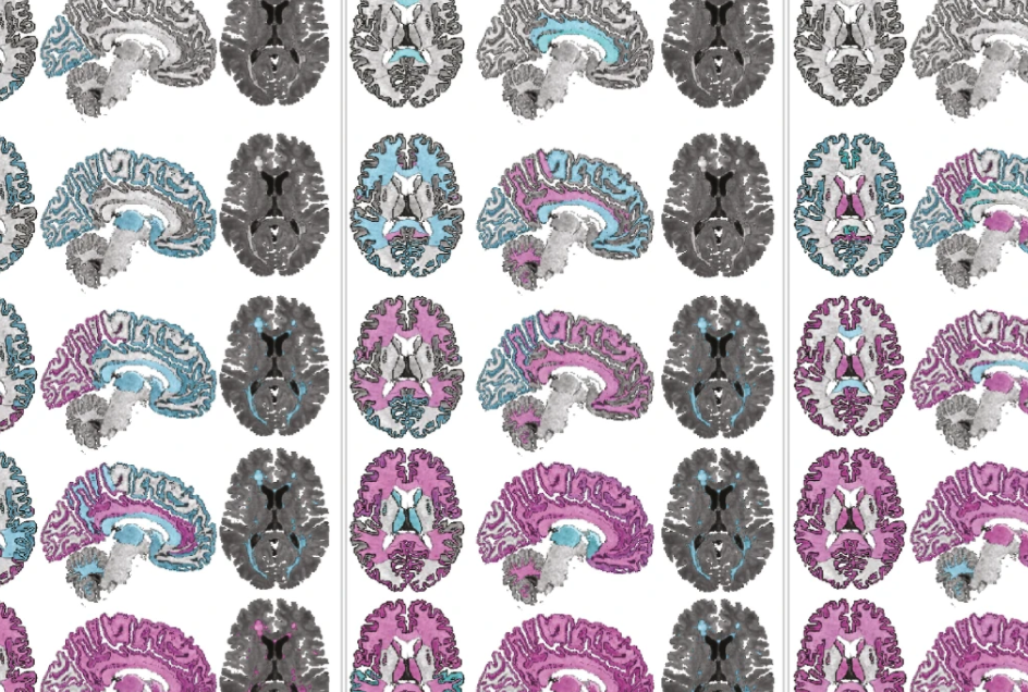 MRI scans of brains showing the evolution of MRI abnormalities in each of the three MRI-based subtypes.